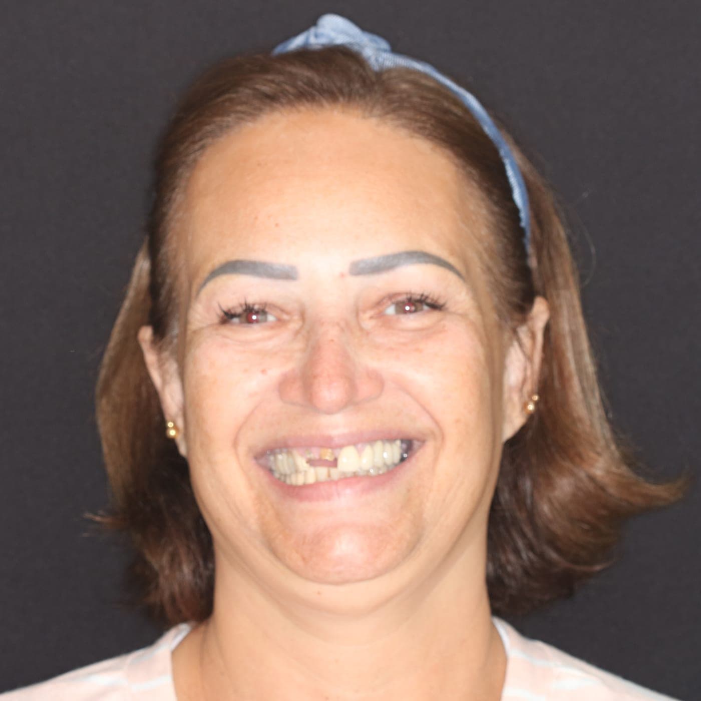 Ana antes — Reabilitação Completa