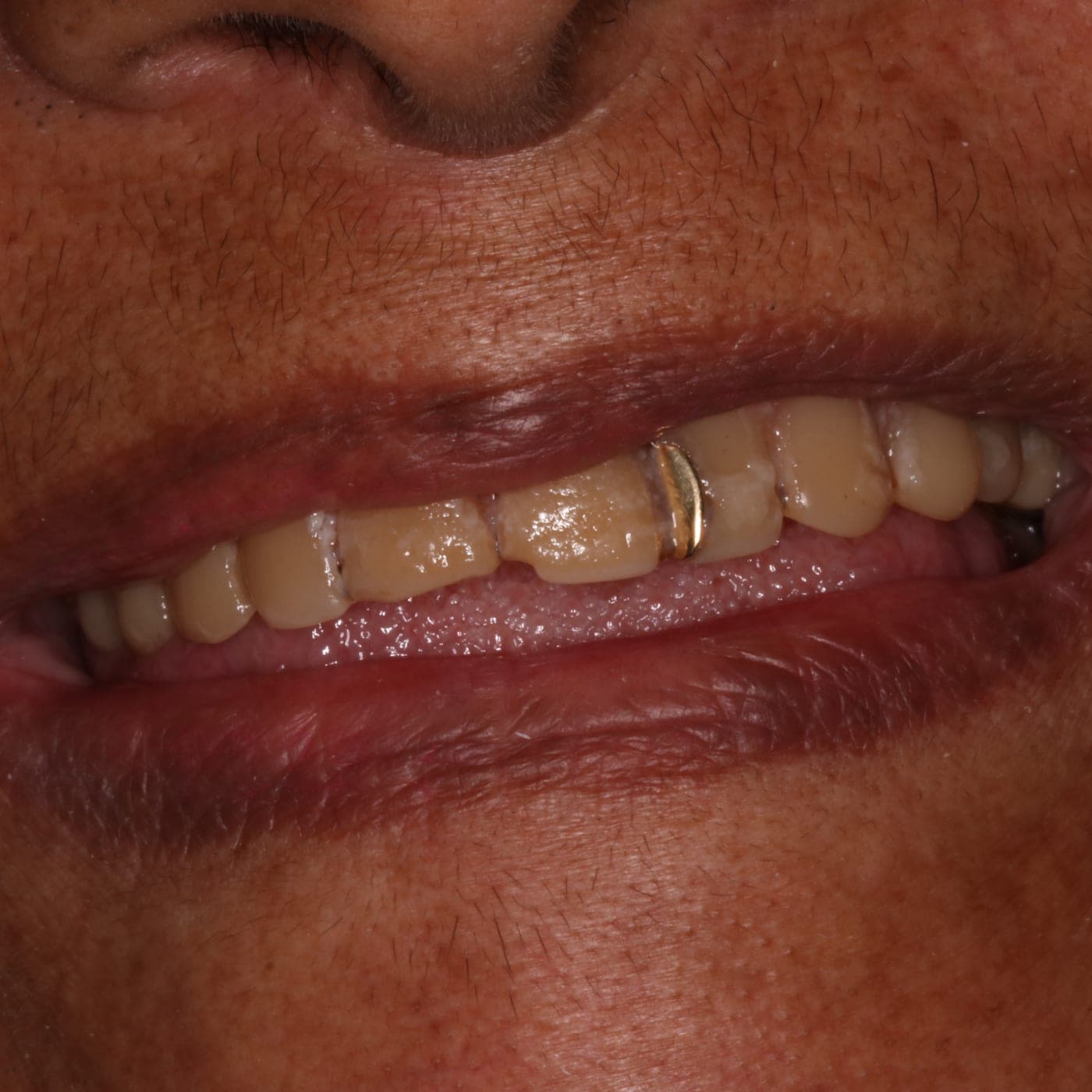 Jocelia antes — Reabilitação Estética