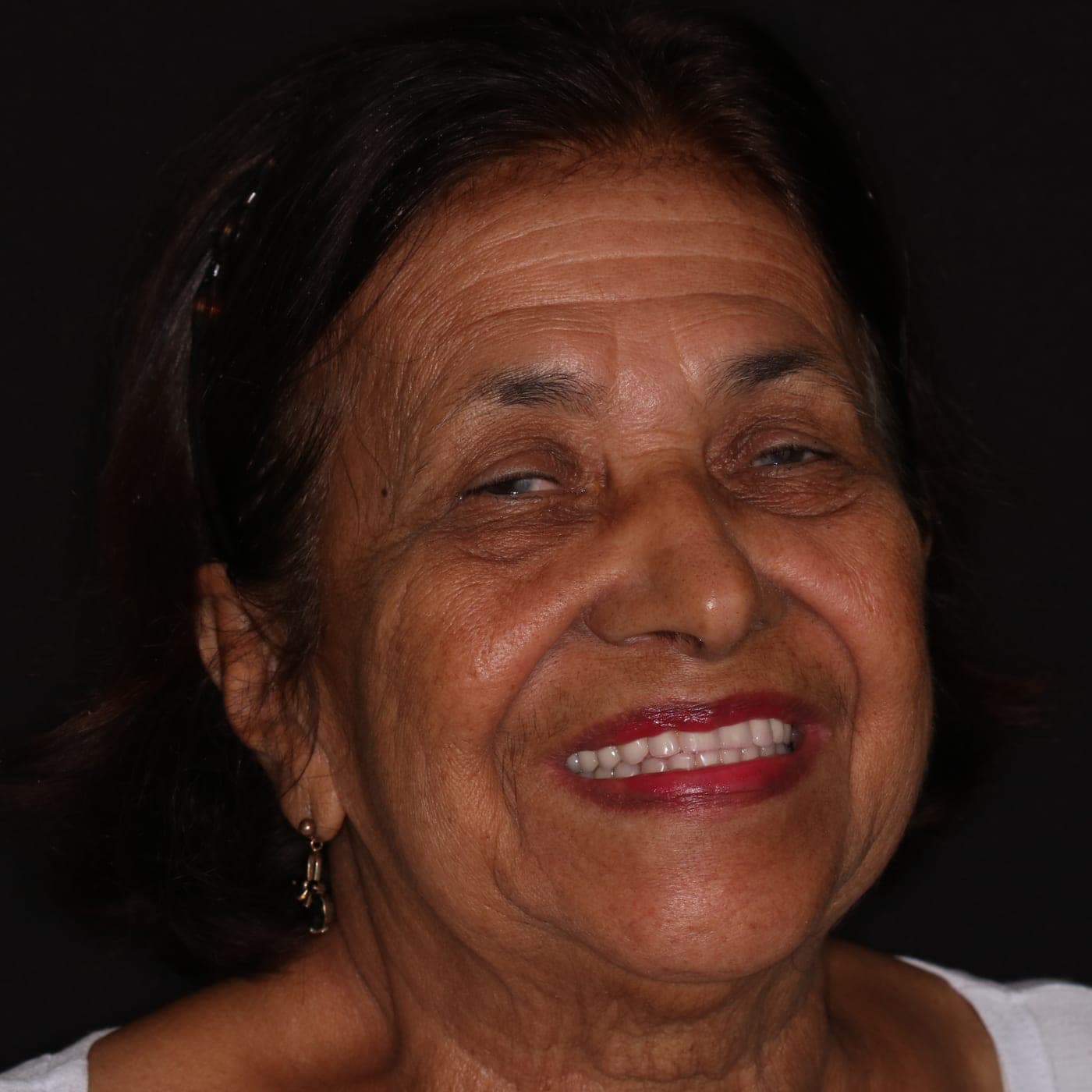 Jocelia depois — Reabilitação Estética